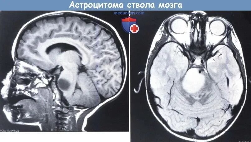 Глиома головного ствола. Опухоль головного мозга глиома. Астроцитарная опухоль головного мозга.