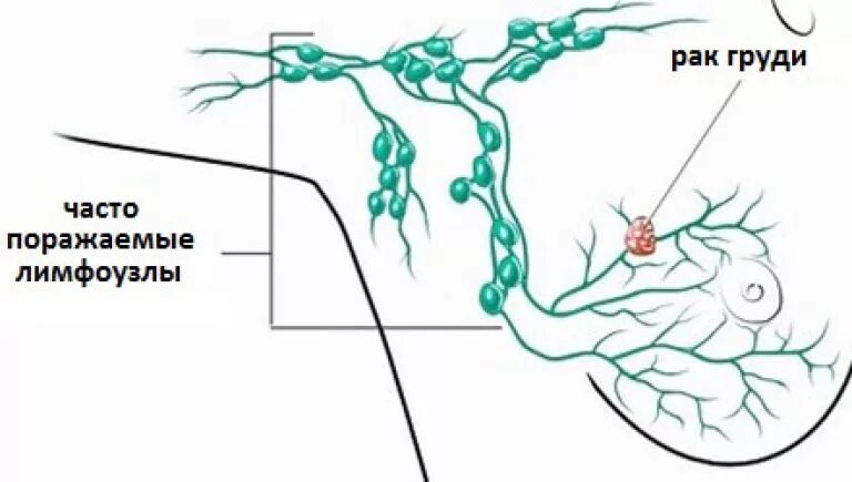 где под мышкой находится лимфатический узел. расположение лимфоузлов в подмышечной впадине схема. лимфоузлы подмышек схема. где лимфоузлы подмышкой. схема расположения лимфоузлов подмышками.