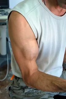 Спазмы бицепса