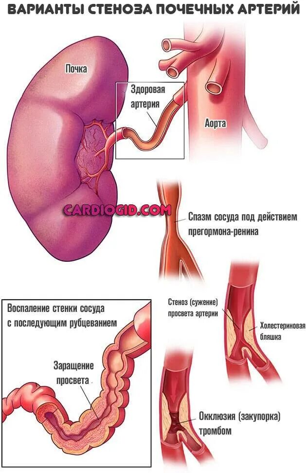 Стеноз что это такое простыми словами