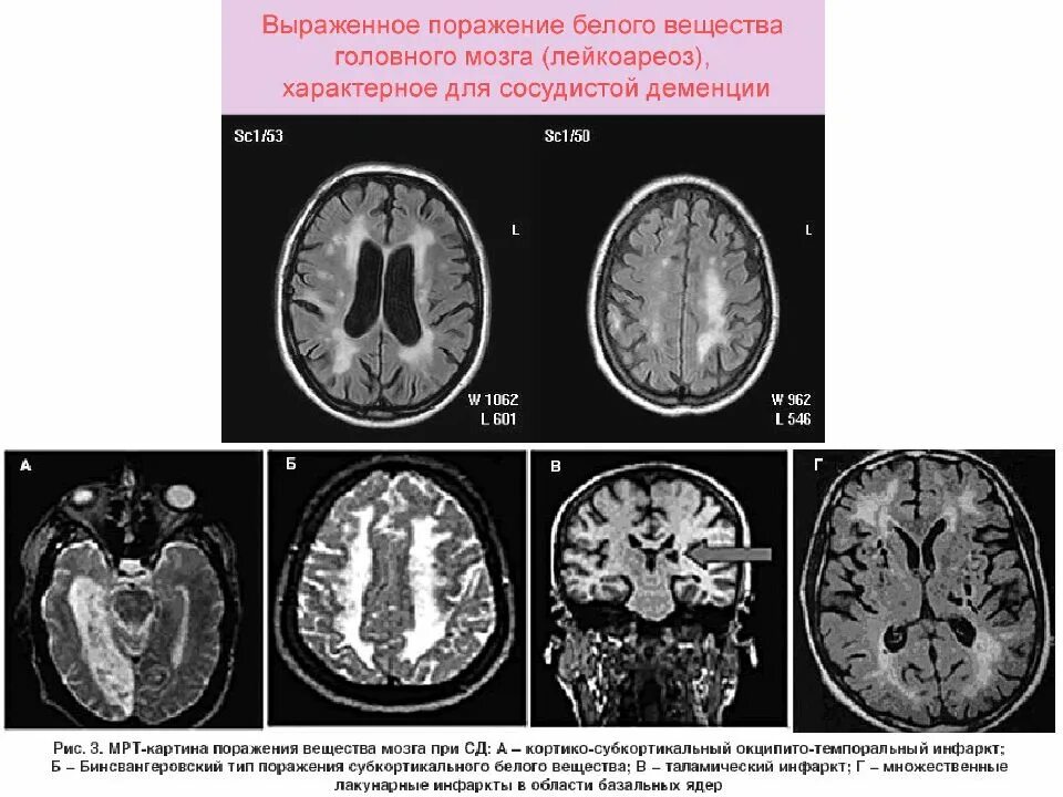 Сосудистая деменция это. Мрт головного мозга при сосудистой деменции. Сосудистая деменция поражение мозга. Поражение головного мозга при деменции. Васкулярная деменция.