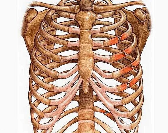 Слом ребра. 10. Перелом реберного хряща рентген. Поднадкостничный перелом ребра. Неконсолидированный перелом ребра на кт.