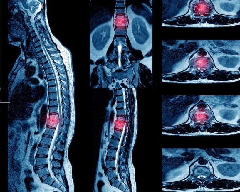 Мрт спинного отдела. Мрт снимки грудного отдела позвоночника. Спондилит на мрт позвоночника. Мрт грудного отдела позвоночника норма. Мрт снимок позво.
