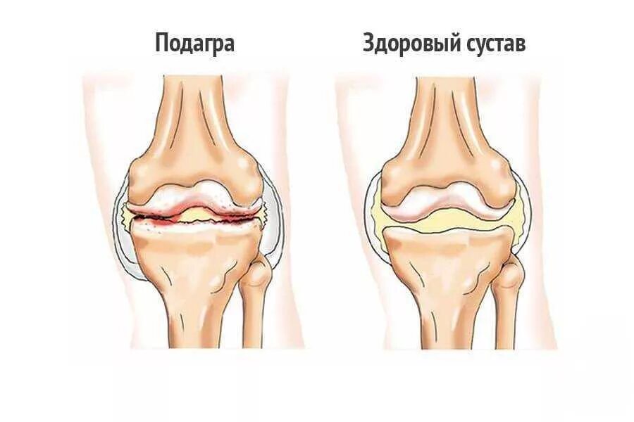 Артроз коленного сустава симптомы. Деформирующий остеоартроз (доа). первичный деформирующий остеоартроз. пателлофеморальный артроз коленного сустава что это такое. деформирующий артроз (остеоартроз).