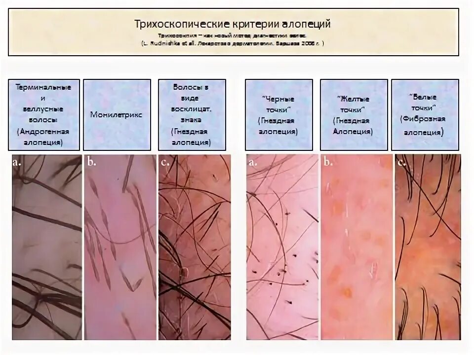 Как выглядит здоровая кожа головы Можно ли заразиться педикулезом в городском автобусе или в школьном гардеробе -