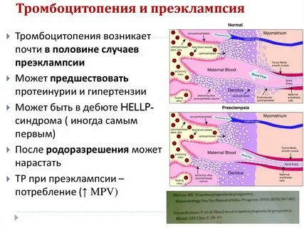 Тромбоцитопения что это простыми словами у женщин