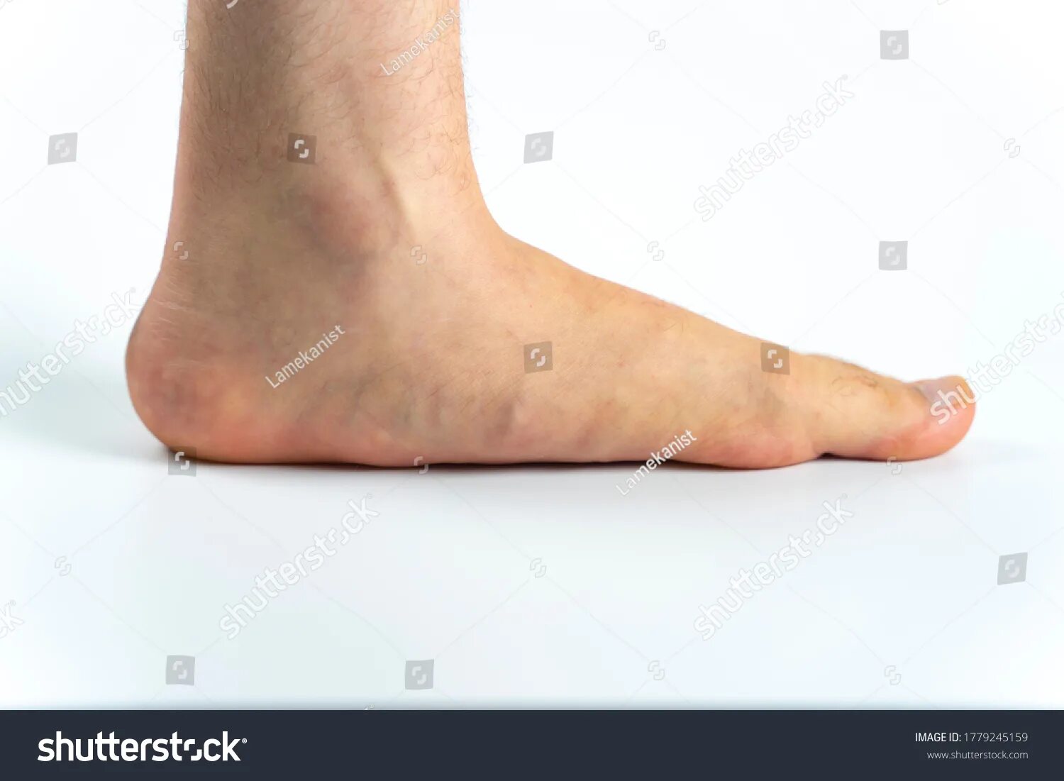 Ножка плоская. Плоскостопие. Плоская стопа [pes planus] (приобретенная). Плоскостопие. Плоскостопие картинки.