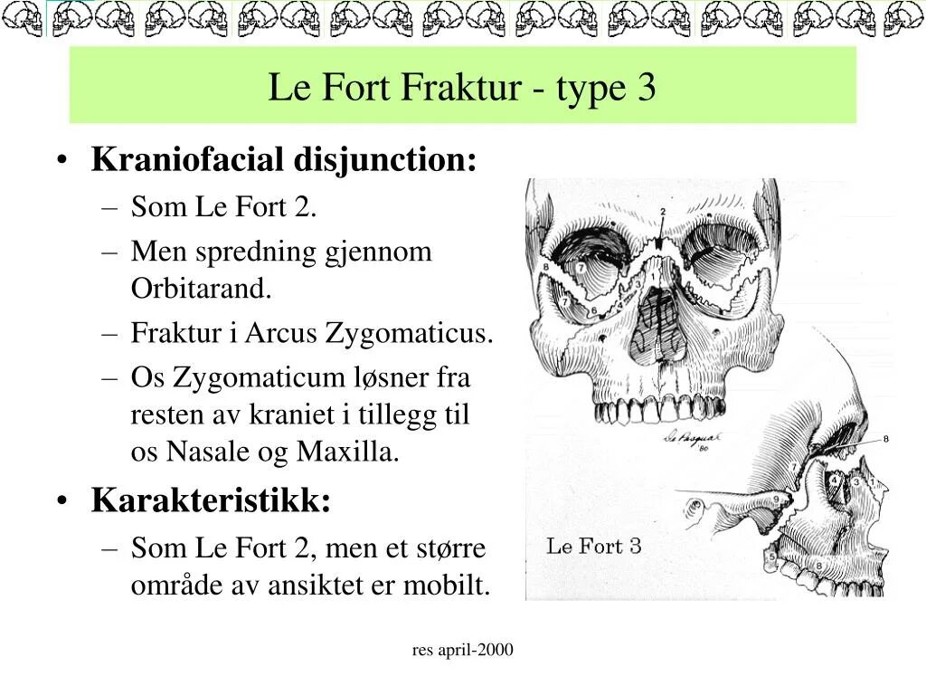Le fort. Zygomaticus латынь транскрипция. Fraktur и немецкая культура.
