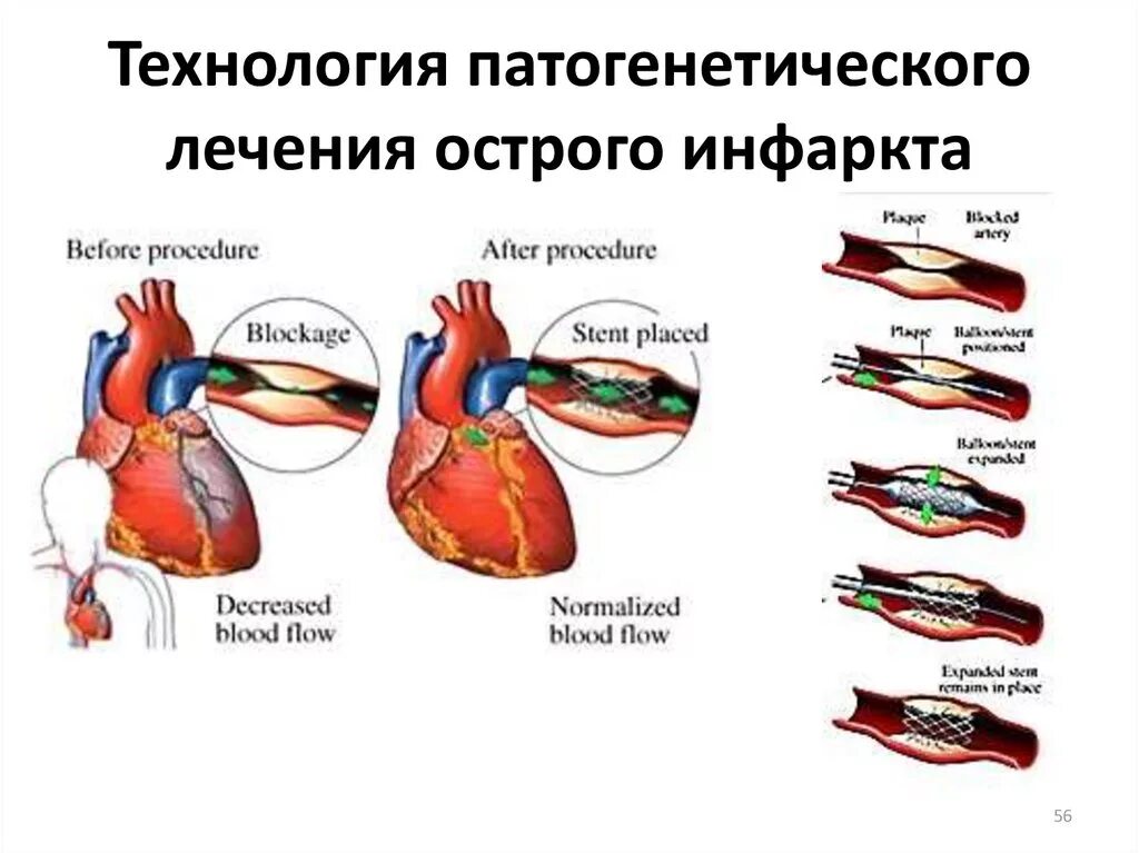 Острая коронарная недостаточность смерть причины. Коронарная недостаточность. Последствиями острой коронарной недостаточности являются. Формы острой коронарной недостаточности. Синдром коронарной недостаточности.