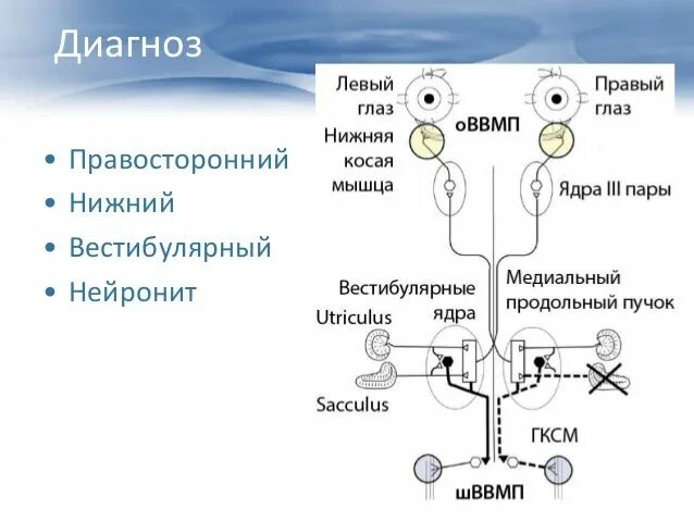 Нейронит причины. Схема лечения вестибулярного нейронита. острый вестибулярный нейронит. правосторонний вестибулярный нейронит. вестибулярные миогенные вызванные потенциалы.