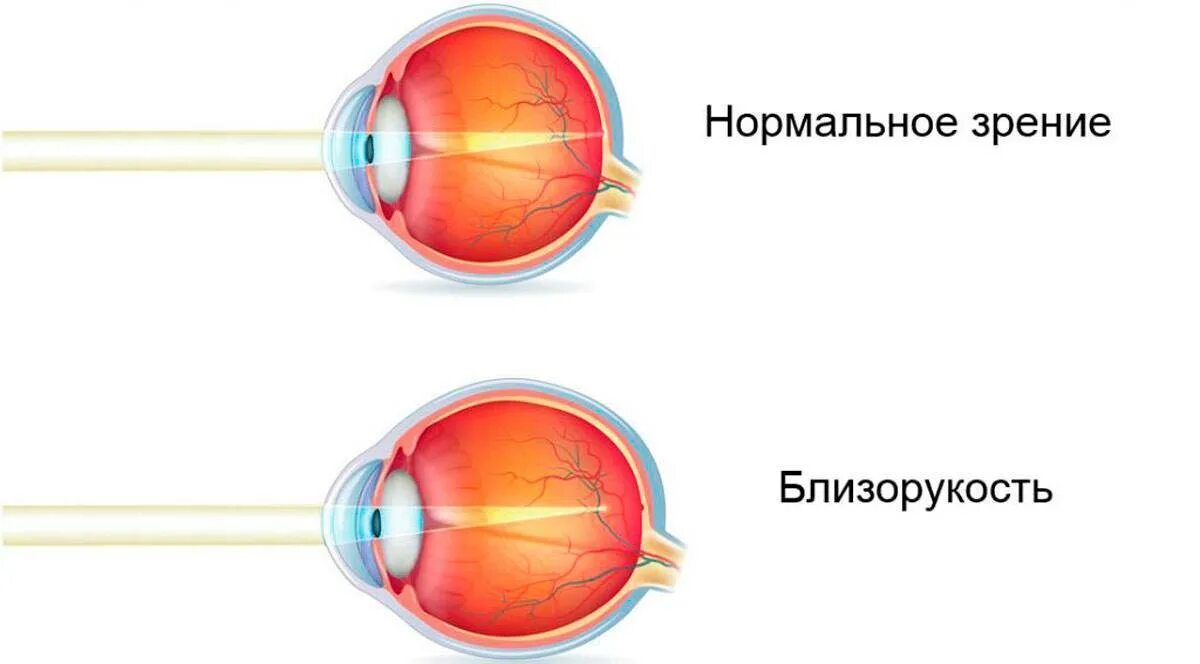 Миопия что это такое у детей. Миопия глазное яблоко. Форма глаза при близорукости. Глаз человека строение миопия. Неправильная форма глазного яблока при дальнозоркости.