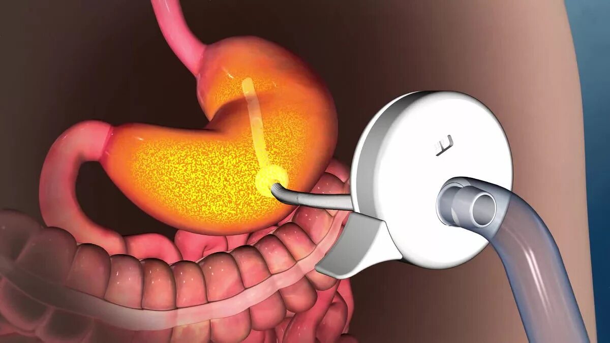Трубка в желудок для питания. Гастро трубка для питания. Гастростома свищ желудка. Маркеры желудка