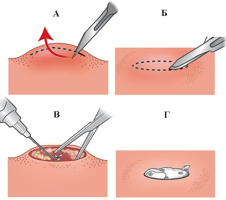 Ножевая биопсия. Вскрытие подкожной гематомы. Хирургический дренаж для фурункула.