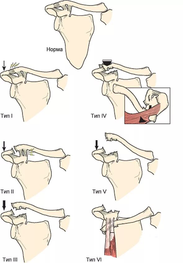 вывих акромиального конца ключицы рентген. разрыв акс плечевого сустава степени. артроз акромиально-ключичного сочленения сочленения. обызвествление акромиально-ключичной связки. разрыв акс плечевого сустава степени.