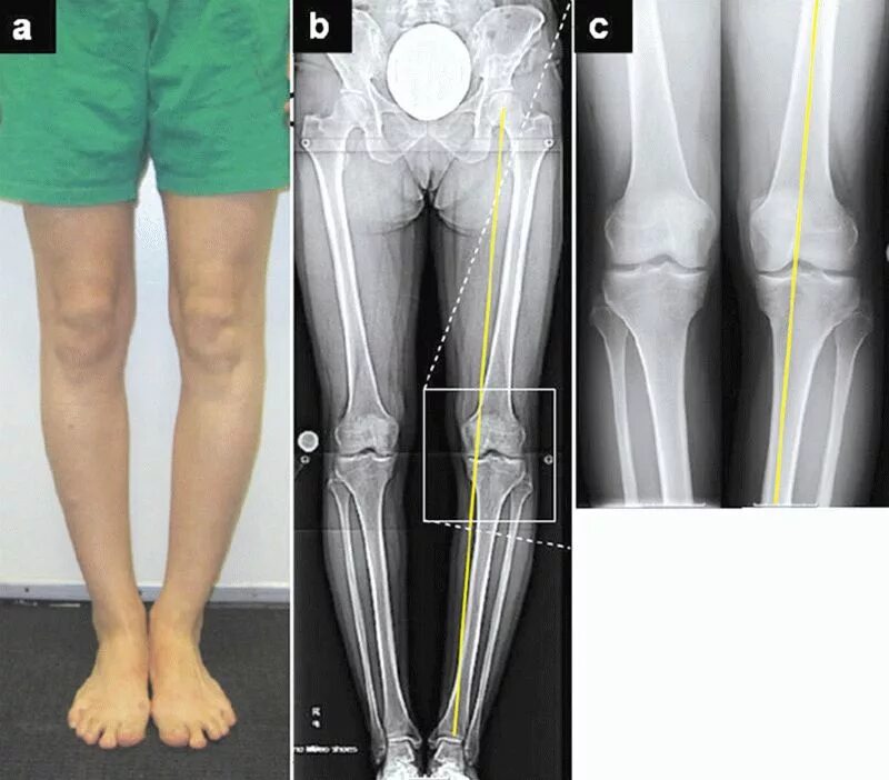 Деформация коленного сустава у детей. Вальгусная деформация коленных суставов рентген. Варусная деформация оси нижних конечностей. Вальгус коленных суставов рентген. Вальгус деформация коленных суставов.