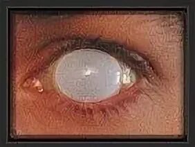 Pin on Society White eyes, Eyes, Blind eyes