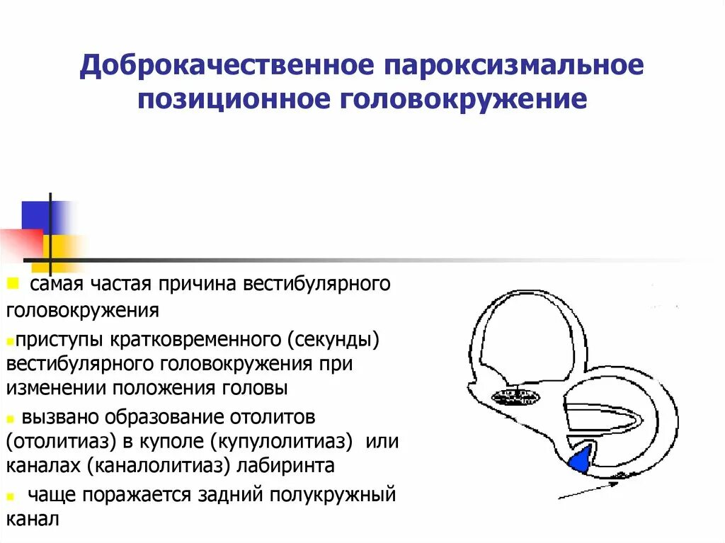 При поворотах головы кружится голова причины. Доброкачественная параксизмальнаяпозиционное головокружение. Доброкачестественное позиционное головокружение. Доброкачественное пароксизмальное позиционное головокружение. Доьрокачественное пощиционное головкружение.