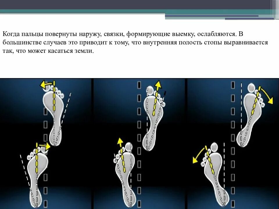 Варусная деформация стоп. Круговое вращение стоп. Плоскостопие пронация стопы. Вальгус варус плоскостопие. Фигуры со ступнями направленными наружу.