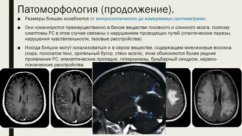 Изменения вещества мозга дистрофического характера