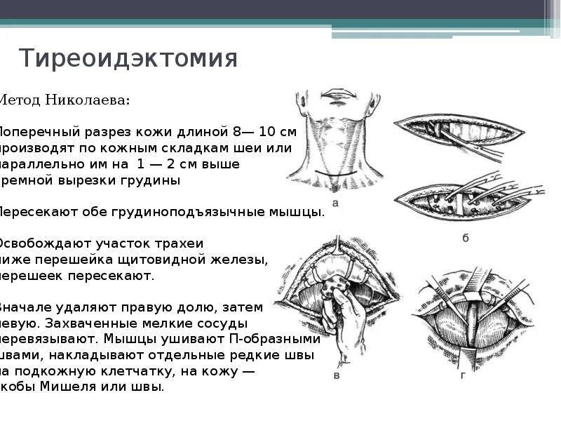 Тиреоидэктомия методика операции. Тиреоидэктомия метод кохера. Гемитиреоидэктомия щитовидной железы этапы операции. Тиреоидэктомия щитовидной железы ход операции. Щитовидная железа операция стоимость