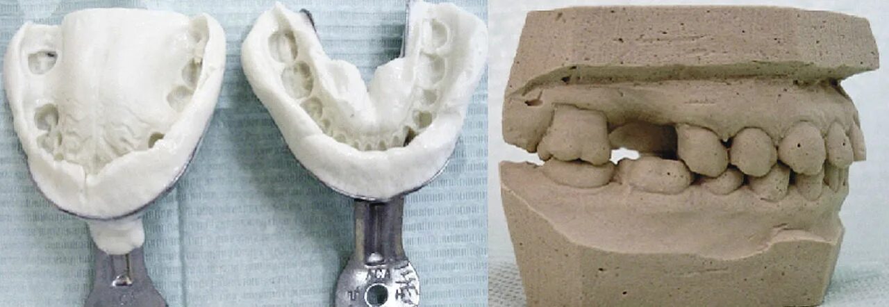 Оттиски в ортопедической стоматологии. Слепок зубов. Методики получения оттисков в стоматологии. Получение оттисков (клинический этап). Получение модели и оттиска.