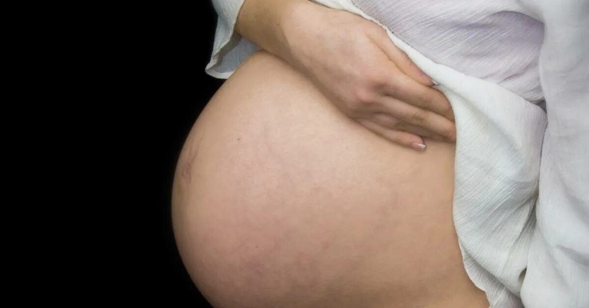Во время беременности появляется. Беременный живот с растяжками. Растяжки при беременности.