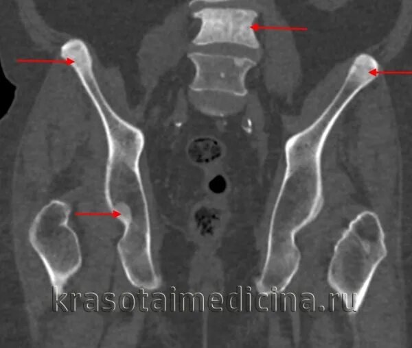 Вторичное поражение костей. Болезнь Педжета костей таза кт. Остеосклероз бедренной кости на кт. Метастазы в кости таза кт. Остеосклеротический очаг на кт.