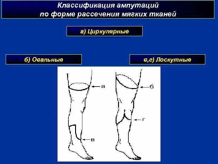 Ампутация бедра классификация. Ампутация нижней конечности средняя треть бедра. Классификация ампутаций стопы. Этапы ампутации нижней конечности.