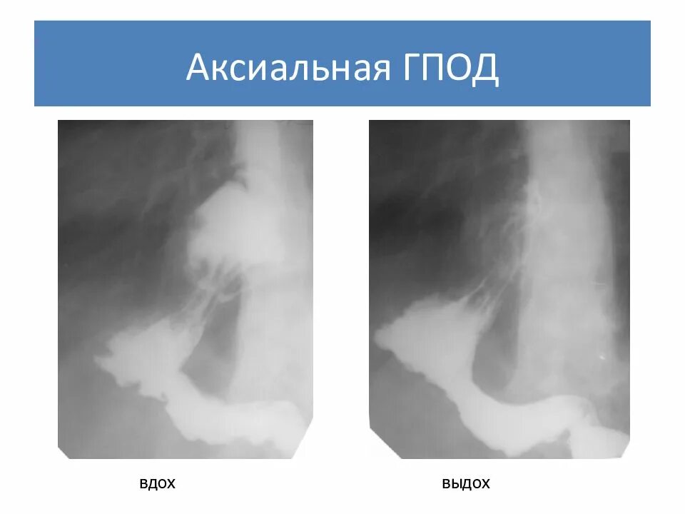 Кардиальная грыжа под. Аксиальная грыжа пищевода рентген. Скользящая грыжа пищевода рентген. Грыжа диафрагмы пищевода рентген. Аксиальная скользящая грыжа рентген.