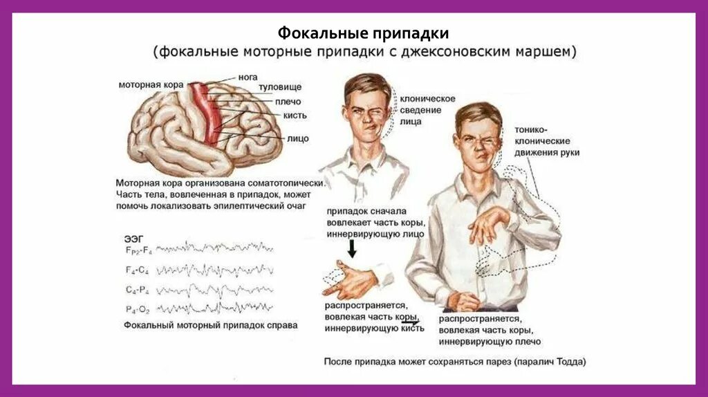 Первые признаки эпилепсии. Эпилепсия судорожный синдром. Судорожный припадок симптомы. Генерализованный тонико-клонический приступ. Фокальная эпилепсия.