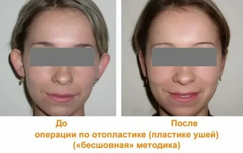Операция на уши отзывы