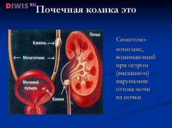 Почечная колика у детей. Плакат почечные колики. Почечные колики сообщение. Правосторонняя почечная колика. Мочекаменная болезнь почечная колика