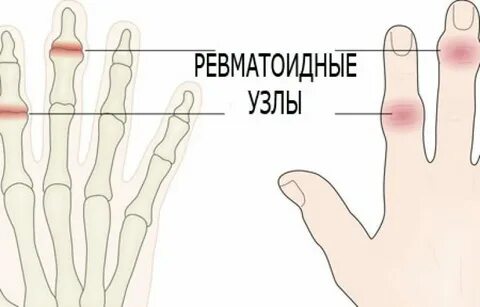 Фалангов пальцев