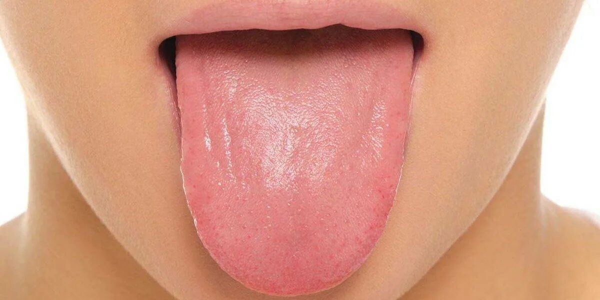 Налет на языке о чем говорит таблица. Желучный налет на языке. Kg язык. Глоссит атрофированный. Kg язык.
