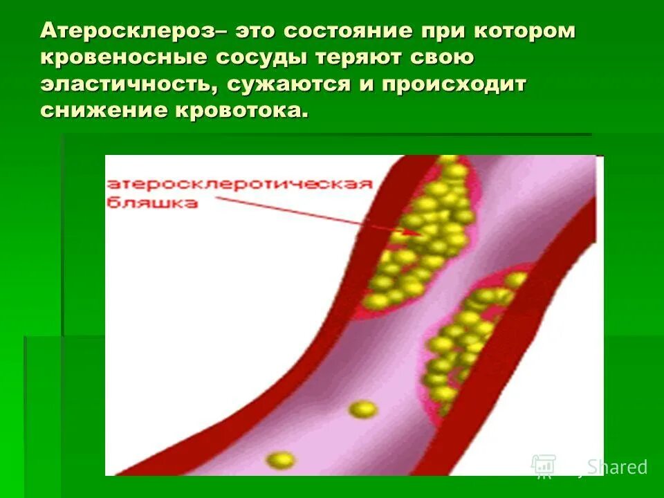 Атеросклероз это хроническое заболевание. Атеросклероз это простыми словами. Атеросклероз это простыми словами. Атеросклероз и артериосклероз различия. Атеросклероз это простыми словами.