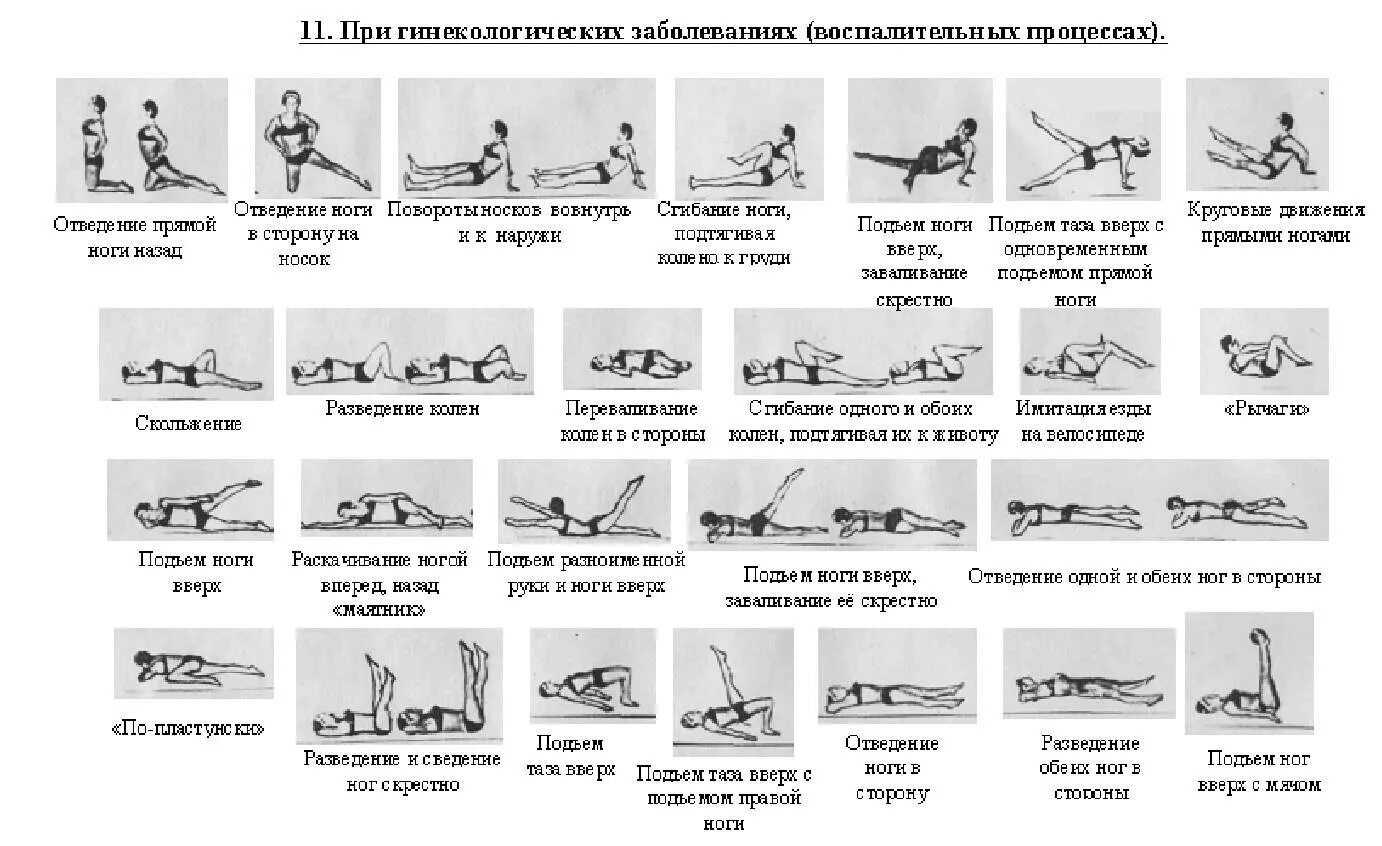 Лфк при гинекологических заболеваниях