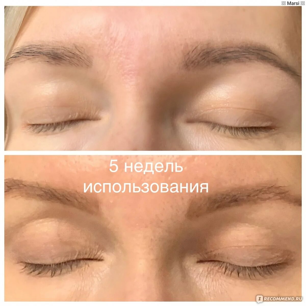 Toplash для роста ресниц отзывы. Сыворотка для ресниц до и после. ресницы после сыворотки. toplash сыворотка для ресниц до и после. сыворотка для отращивания ресниц.