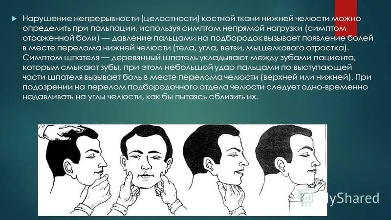 Пальпация перелом нижней челюсти. Болит угол нижней челюсти. Симптом нагрузки при переломах нижней челюсти. Болит угол нижней челюсти при нажатии.