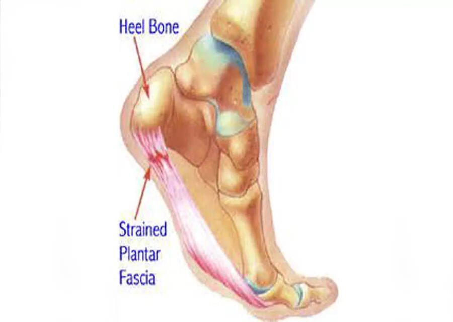 Плантарный фасциит стопы. Фасциит пяточной кости. Боль ноет в пятке