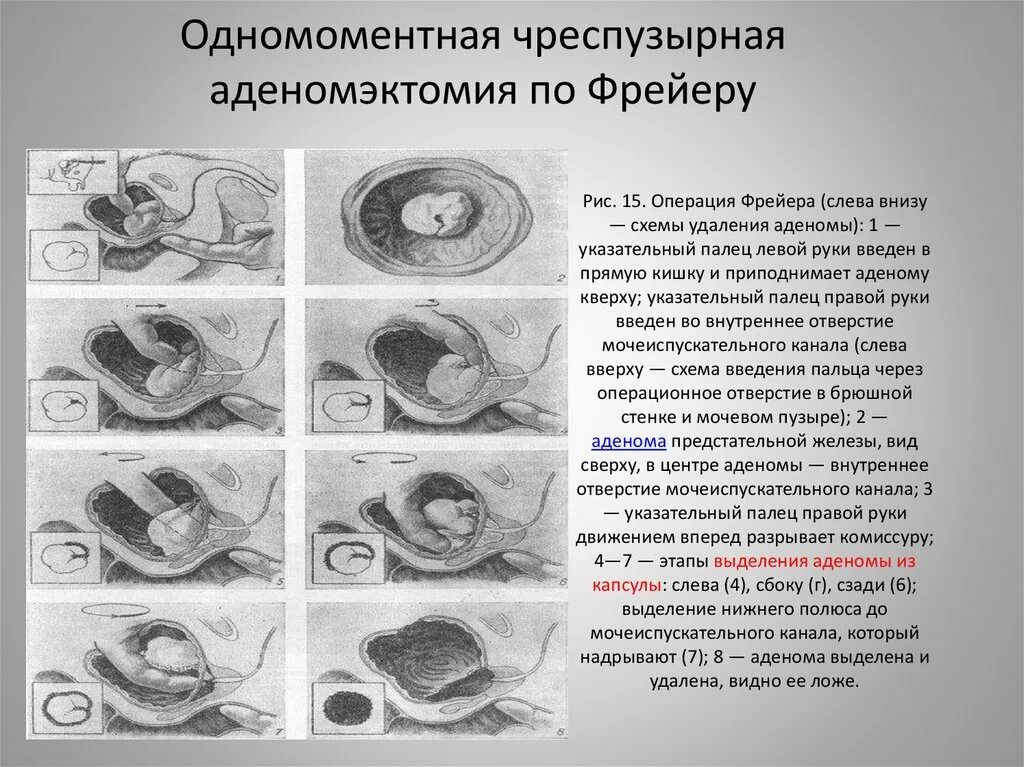 Чрезпузырная аденомэктомия техника. Позадилонная аденомэктомия. Операция Миллина аденомэктомия. Аденомэктомия предстательной железы. Операция простаты последствия отзывы