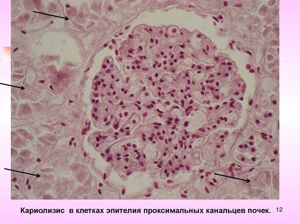 Кариопикноз это. Кариолизис эпителия почечных канальцев. Плоский эпителий почечных канальцев. Кариопикноз кариорексис кариолизис некроз. Кариолизис клеток эпителия извитых канальцев почки.