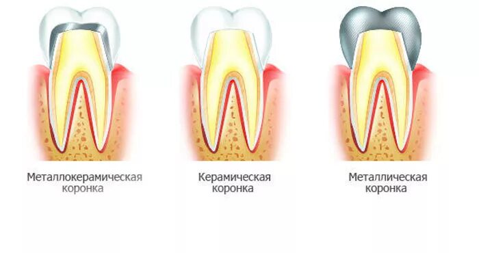 Установление коронки на зуб.