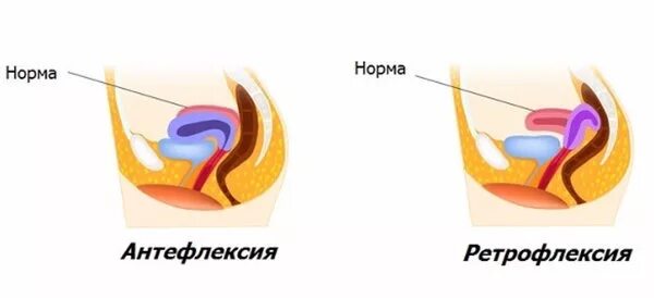 Ретродевиация матки что это такое. Матка anteflexio и retroflexio. положение матки anteflexio versio. расположение матки ретрофлексио. матка расположена в anteflexio versio.