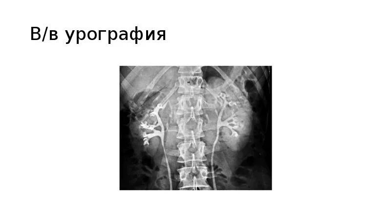После урографии