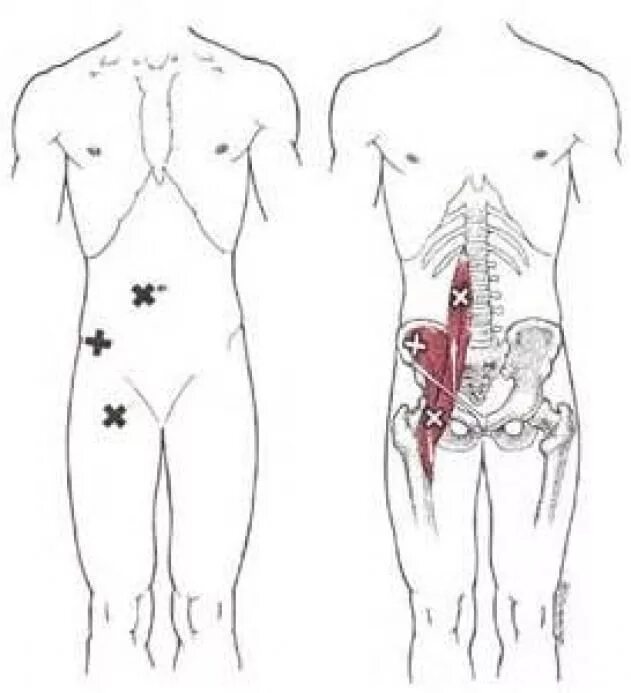 Поясница отдает в пах у мужчин. Тт1 триггерная точка. Миофасциальный синдром живота. Миофасциальный синдром триггеры. Триггерные точки пояснично крестцового отдела.