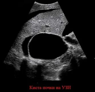 Киста почки может рассосаться