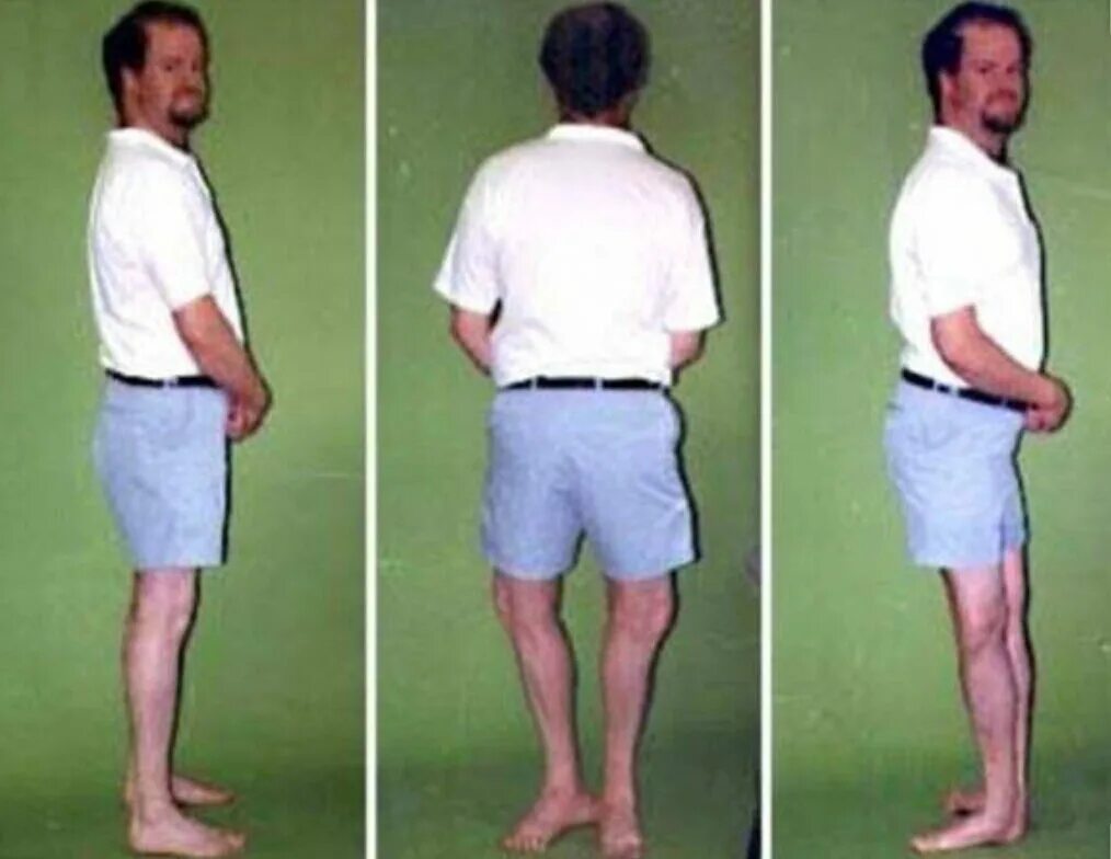 Гипермобильность коленного сустава. Выгнуто наружу. Битиласана. Сгиб наружу это. Сгиб наружу это.