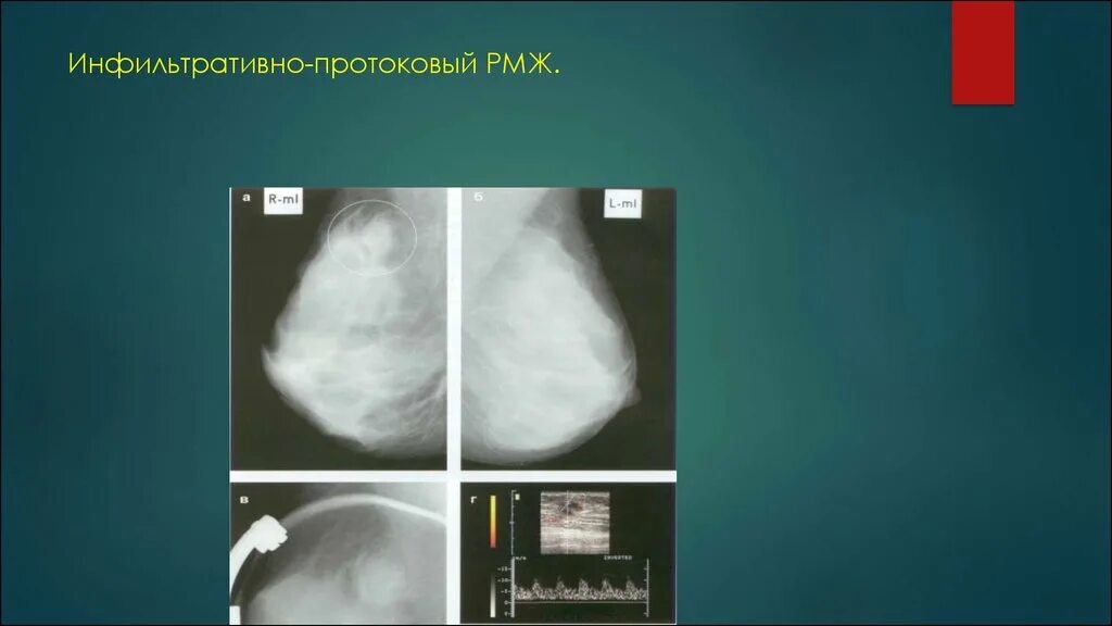 Инфильтрированная опухоль. Инфильтративная форма молочной железы. Инфильтрирующая протоковая карцинома. Инфильтративная опухоль молочной железы. Отечно инфильтративная форма молочных желез.