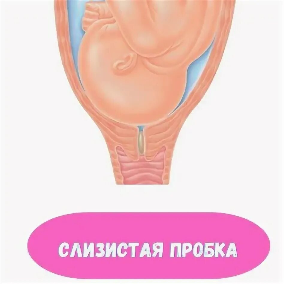 Как выглядит отошедшая пробка Картинки ПОСЛЕ ОСМОТРА ОТОШЛА ПРОБКА