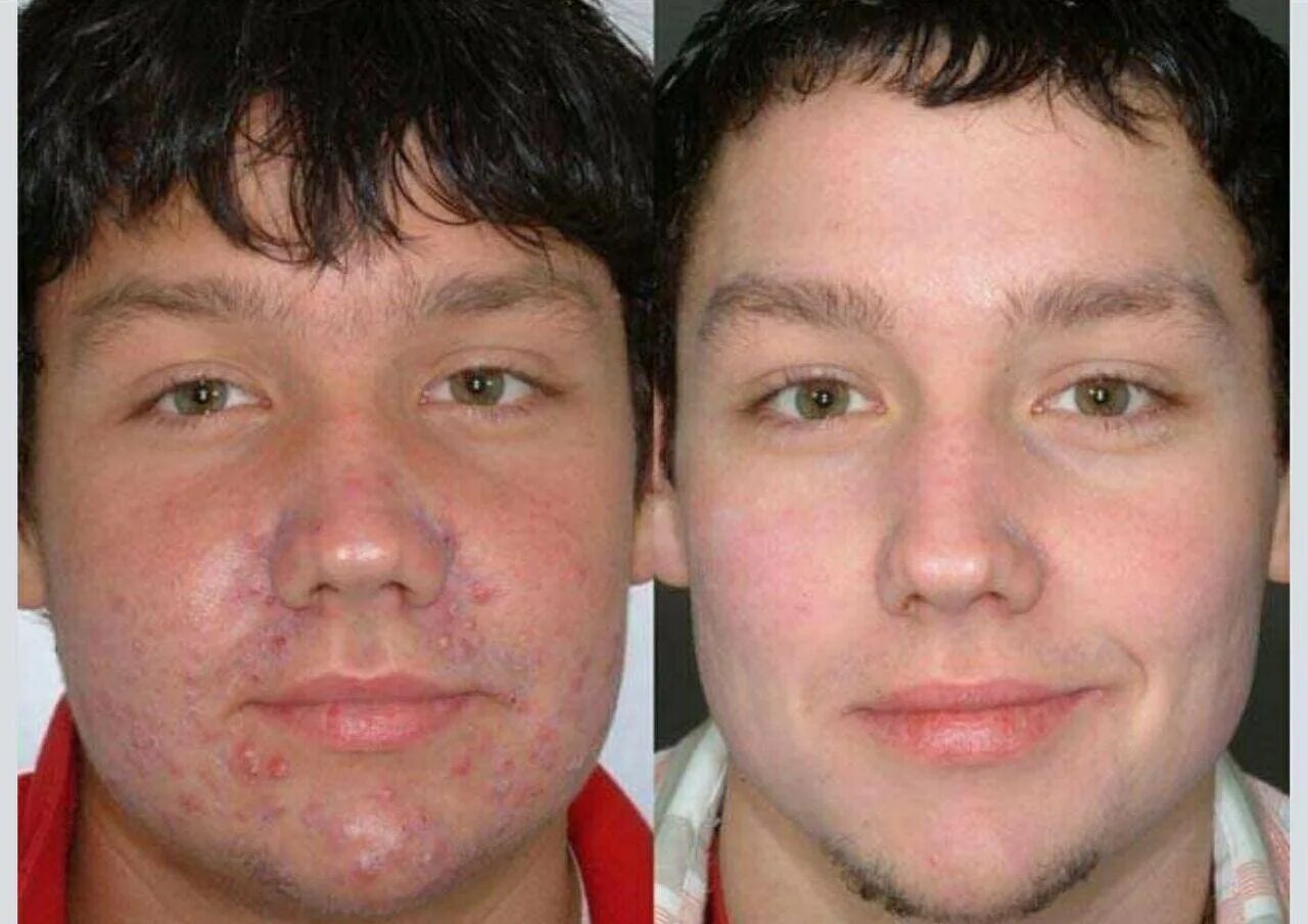 Лицо до и после косметолога. Лицо после механической чистки. Химический пилинг до и после.